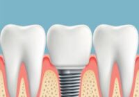 A Dental Implant That Protects Teeth From The Inside