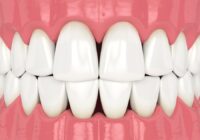 All About Gingival Embrasures