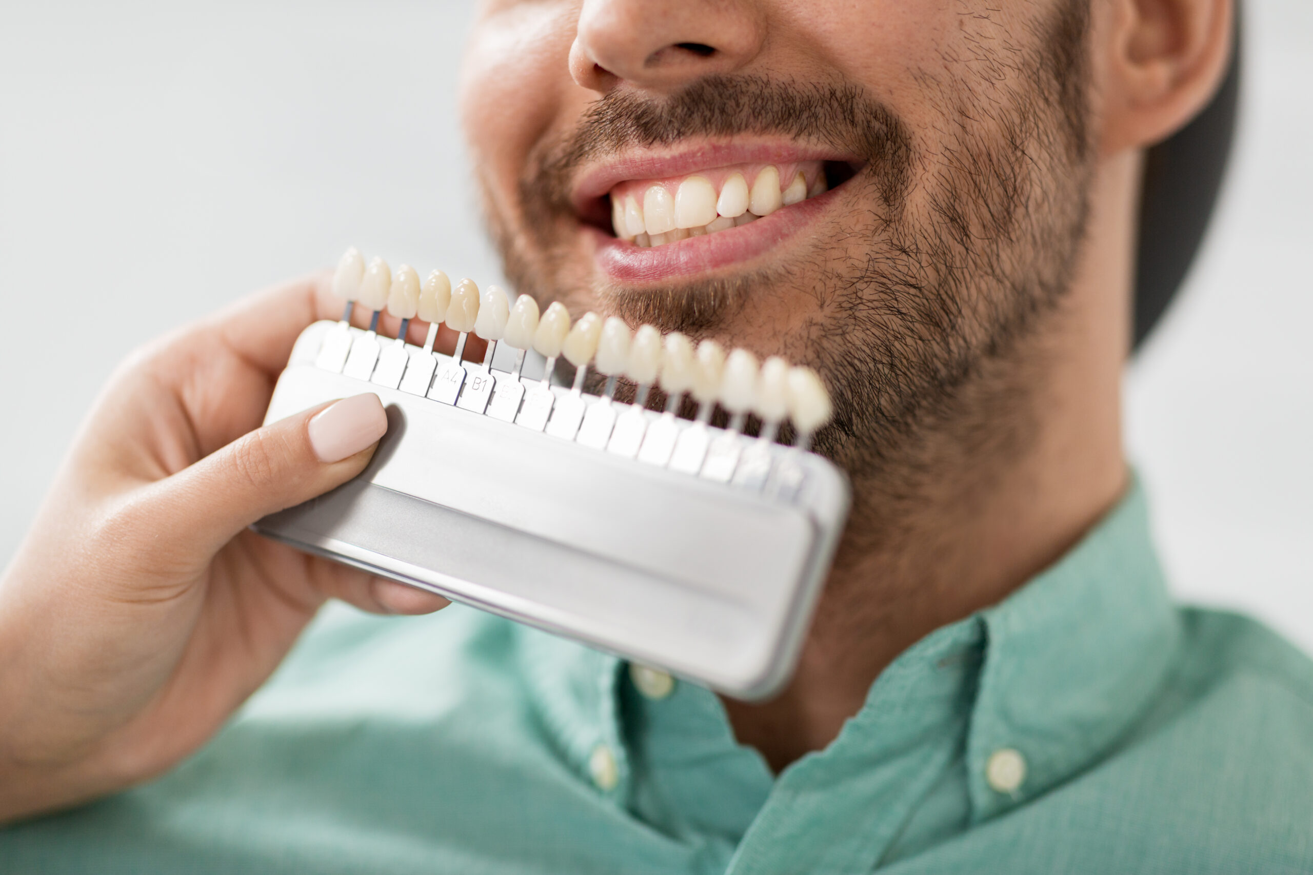 Quick Questions About Veneers