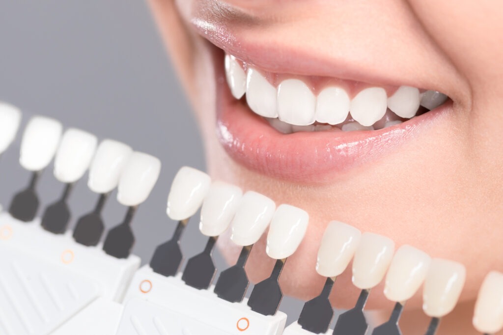 Choosing The Right White For Your Veneers